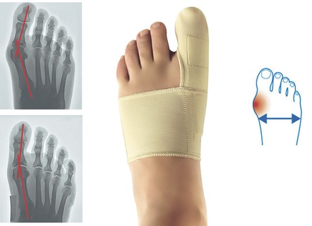 ‘Epitact’ corrigerende orthese hallux valgus