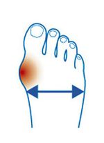 ‘Epitact’ corrigerende orthese hallux valgus HUIDKLEUREN