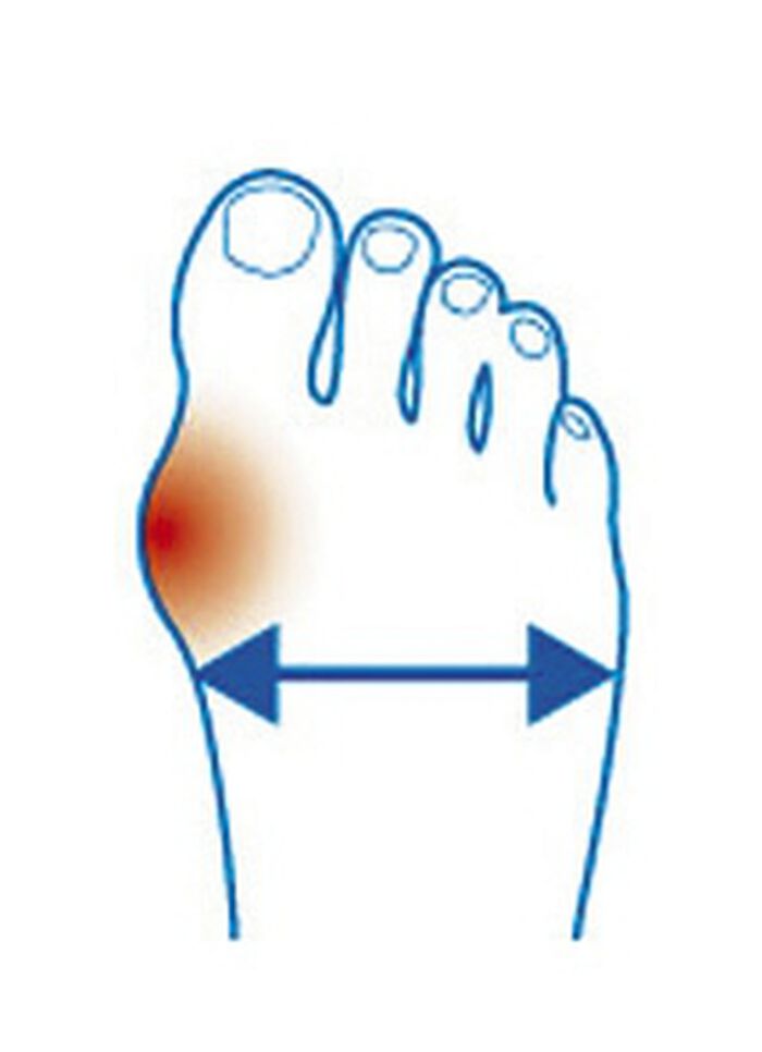 ‘Epitact’ corrigerende orthese hallux valgus HUIDKLEUREN