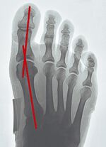‘Epitact’ corrigerende orthese hallux valgus HUIDKLEUREN