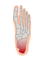 Hielbeschermingsverband 