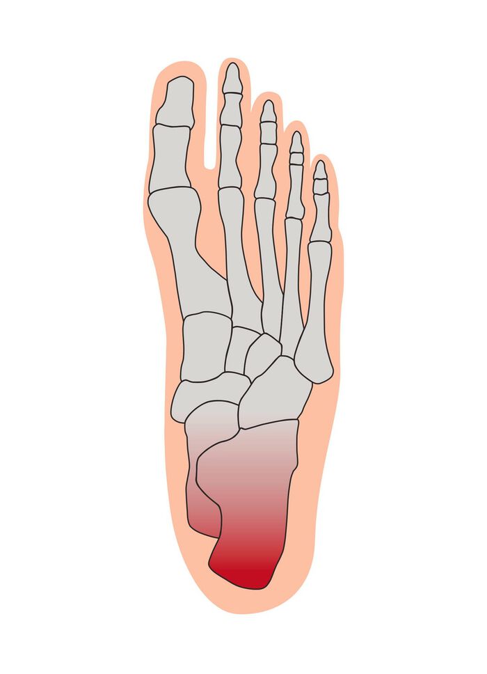 Hielbeschermingsverband 