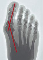 ‘Epitact’ corrigerende orthese hallux valgus HUIDKLEUREN