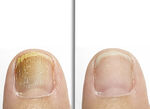 Anti-voet- en nagelschimmelspray 